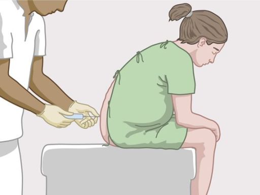 181 epidurale verdoving
