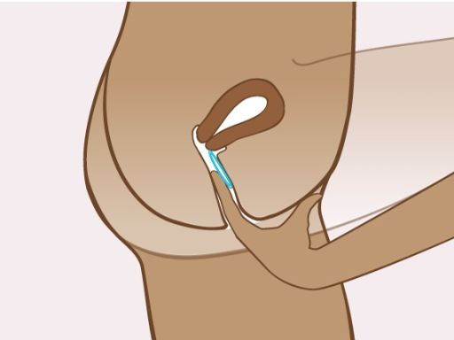 191021 einsetzenvaginalrings 1