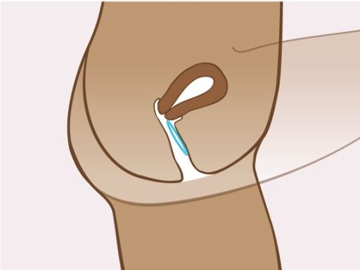 191021 einsetzenvaginalrings 2
