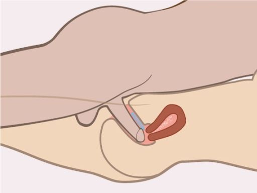 191021 einsetzenvaginalrings 3