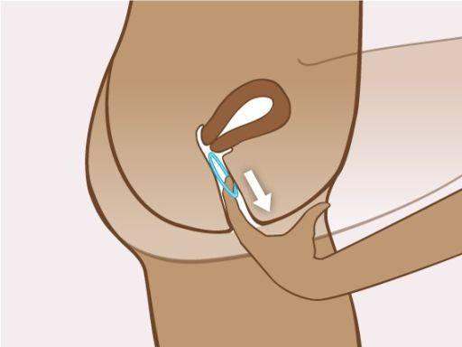191021 einsetzenvaginalrings 4