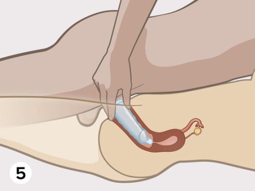 Condom step5