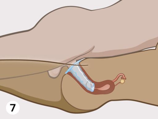 Female condom step7