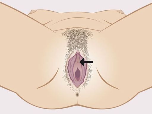 144 urinarymeatus