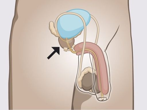 150 prostate