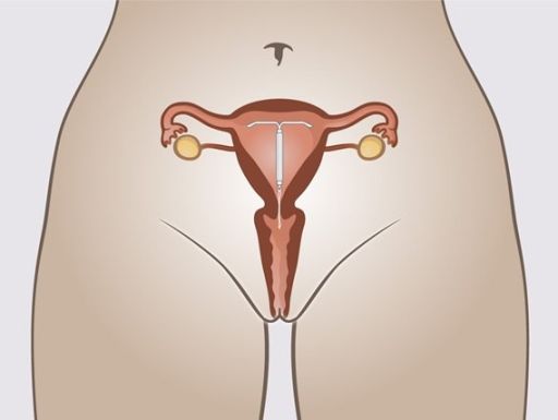 176 iud