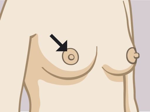 186 areola