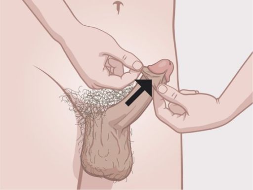213 foreskin