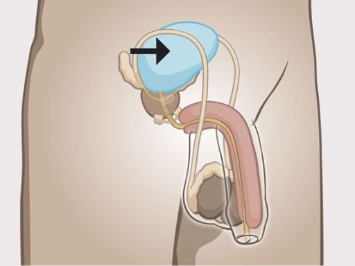 35 bladder